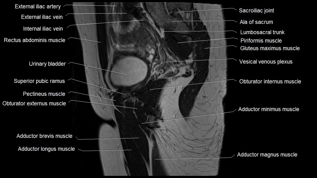 Hip sagittal cross sectional anatomy image 30.webp